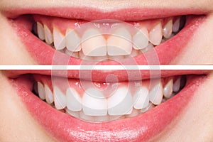 Woman teeth before and after whitening. Over white background. Dental clinic patient. Image symbolizes oral care