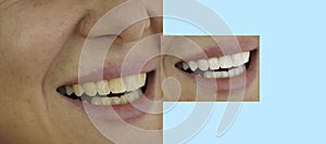 Woman teeth  before and after whitening   perfect
