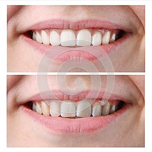 Woman Teeth Before and After Whitening on  white background
