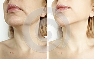 Woman tightening the chin correction collage before and after the procedure treatment