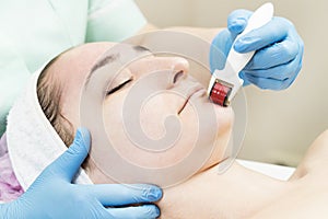 Woman undergoes the procedure of medical micro needle therapy with a modern medical instrument derma roller