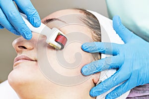 Woman undergoes the procedure of medical micro needle therapy with a modern medical instrument derma roller