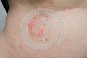 A woman is urticaria on belly photo
