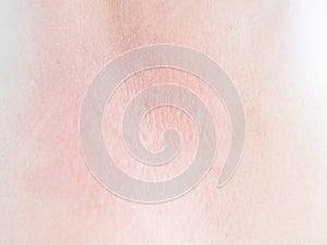 Woman with Urticaria on Skin Non-Lethal Type from Food and Air Poisoning Health,Medicine Body Care Disease Lilness Air,Infection