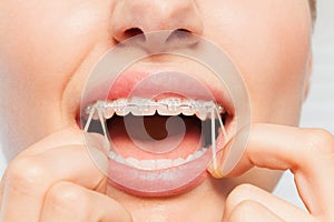 Close-up of woman wearing orthodontic elastic band photo