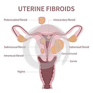 Woman uterine fibroids diagram on white background