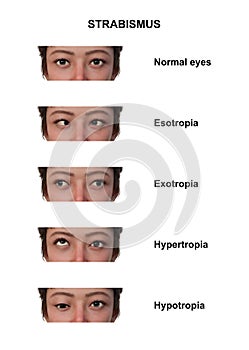 A woman with various strabismus types, 3D illustration