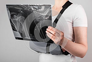Woman wearing arm sling and looking at X-ray image. Female suffering from shoulder, clavicle, acromion fracture, strain photo