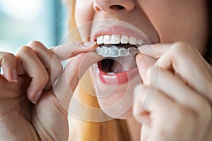 Woman wearing orthodontic silicone trainer. Invisible braces aligner photo