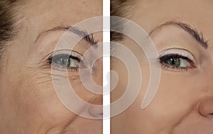 Woman wrinkle eyes before and after procedures