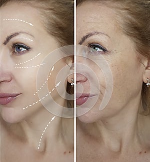 Woman wrinkles anti before after difference mature cosmetology lifting procedures patient
