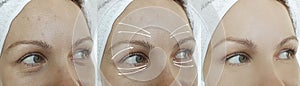 Woman wrinkles arrow sagging bag problem result cosmetology correction after plastic filler