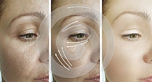 Woman wrinkles arrow sagging problem result skin cosmetology correction after plastic filler