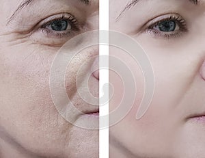 Woman wrinkles beautician on face patient before and after lifting cosmetic procedures