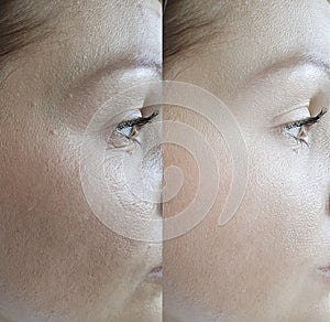 Woman wrinkles beautician regeneration effect collagen mature lifting revitalization before and after treatment result