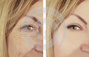 Woman wrinkles before and after correction cosmetology therapy, ageing procedure biorevitalization treatments