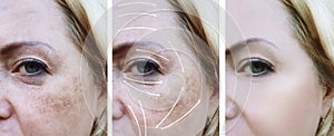 Woman wrinkles correction treatment difference before and after procedures, arrow, pigmentation