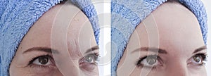 Woman wrinkles before and after difference antiaging procedures