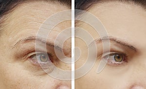 Woman difference wrinkles beautician mature face patient before and after lifting cosmetic procedures contrast