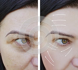 Woman wrinkles difference photo-aging mature before and after rejuvenation procedures ,