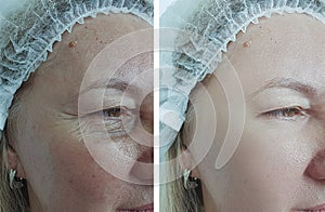 Woman wrinkles difference regeneration cosmetology plastic result before therapy correction after treatment