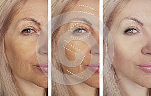 Woman wrinkles before and after difference rocedures, correction