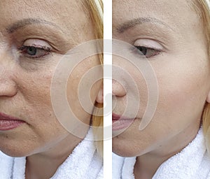 Woman wrinkles before and after effect   correction contrast  results treatments