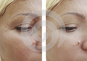Woman wrinkles before after effect cosmetology correction contrast results