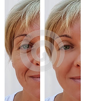 Woman wrinkles on face dermatology treatment correction surgeon before and after health anti-aging procedures photo