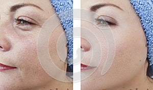 Woman wrinkles face beautician difference before and after treatments