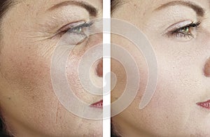 Woman wrinkles face beautician effect therapydifference regeneration before and after treatments