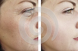 Woman wrinkles face beautician effect therapydifference regeneration before and after treatments photo