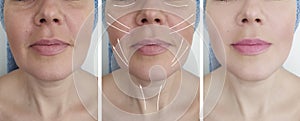 Woman wrinkles face before and after biorev regeneration tension bags, bloating treatment difference correction mature procedures,