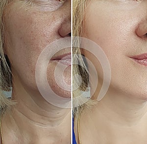Woman wrinkles face before collage after treatments procedure problem
