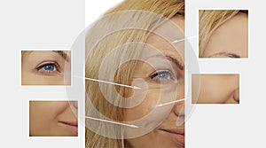 Woman wrinkles face before after collagen surgery patient lifting surgery treatment correction crease lift therapy g