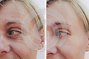 Woman wrinkles on face concept before and after patient injection anti-aging procedures