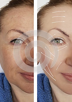 Woman wrinkles face before and after correction dermatology health lifting contrast procedures regeneration