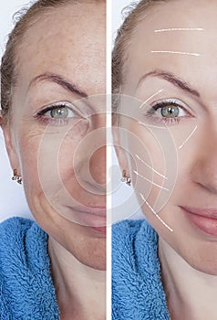 Woman wrinkles face before and after correction dermatology procedures regeneration