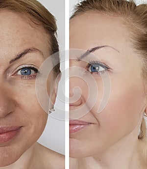 Woman wrinkles face before and after cosmetic procedures