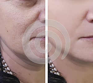 Woman wrinkles on face before and after cosmetic procedures
