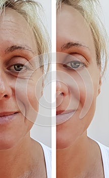 Woman wrinkles on face dermatology correction surgeon before and after health anti-aging procedures