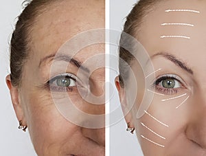 Woman wrinkles face before and after dermatology health lifting contrast procedures regeneration