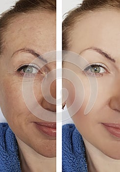 Woman wrinkles face before and after dermatology removal cosmetic procedures difference