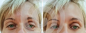 Woman wrinkles on face dermatology surgeon before and after health anti-aging procedures