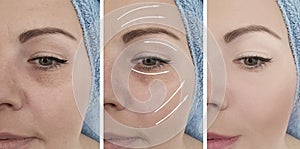 Woman wrinkles face before and after difference bags, bloating treatment difference correction mature procedures,