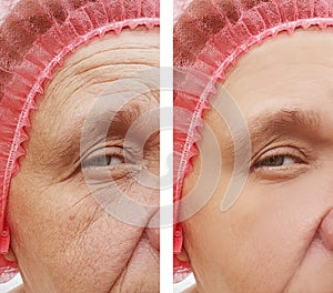 Woman wrinkles on face, difference patient age therapy correction removal dermatology before and after procedure health s