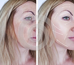 Woman wrinkles face difference before and after procedures effect