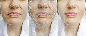 Woman wrinkles face before and after difference therapy correction collage arrow