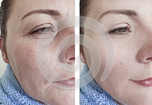 Woman wrinkles face  difference  therapy before and after treatments