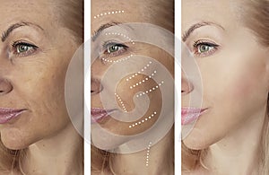 Woman wrinkles face difference before and after treatments